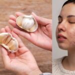 Does Eating Garlic Help with Acne?