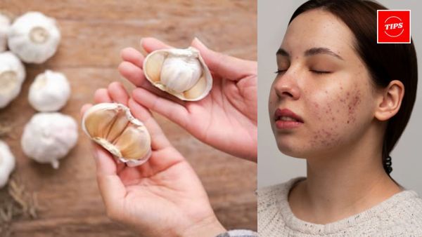 Does Eating Garlic Help with Acne?